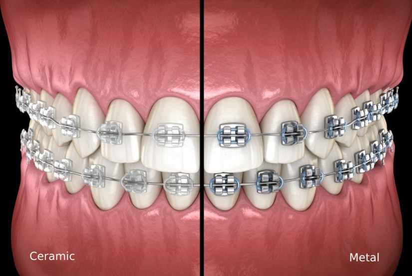 Ceramic vs Metal Braces