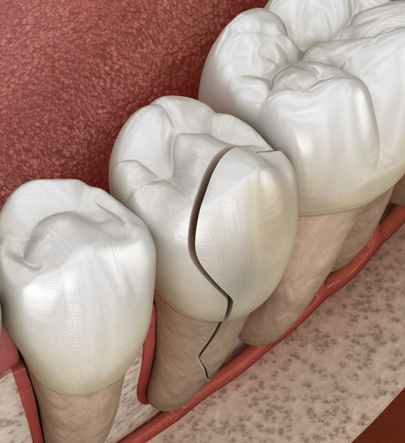 Chipped Tooth Repair in Katy, TX