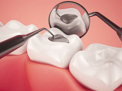 Composite Fillings - Restorative Dentist in Katy, TX