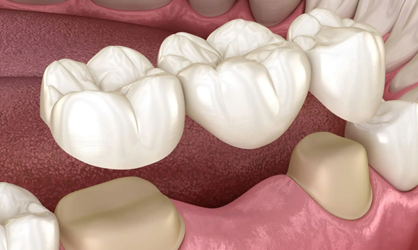 Dental Bridges in Katy, TX