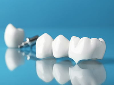 Dental Bridges - Restorative Dentist in Katy, TX