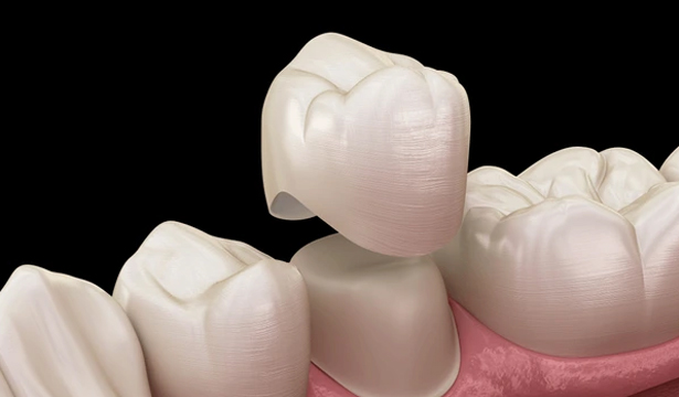 Dental Crowns in Katy, TX