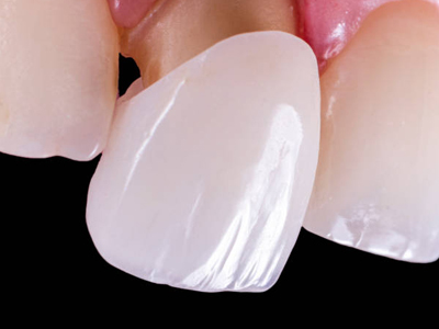 Dental Crowns - Restorative Dentist in Katy, TX