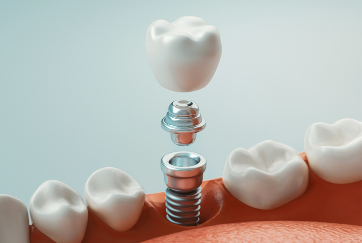 Dental Implants in Katy, TX