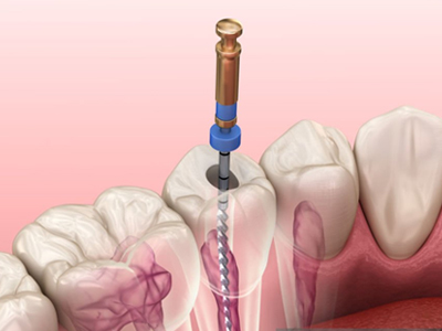 Root Canal Therapy - Restorative Dentist in Katy, TX