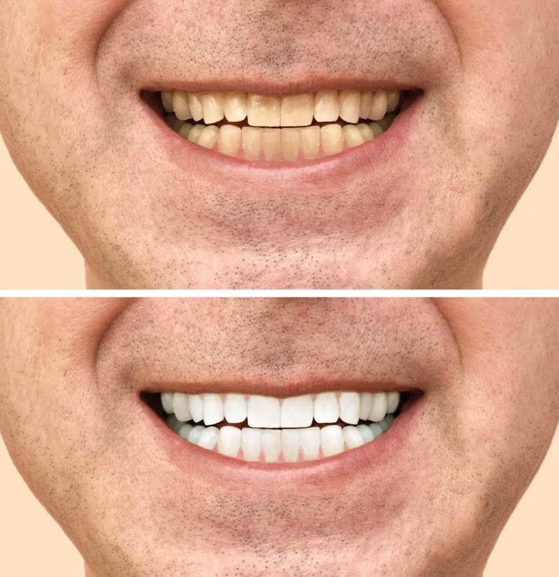 Teeth Whitening in Katy, TX