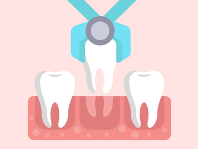 Tooth Extractions - Restorative Dentist in Katy, TX