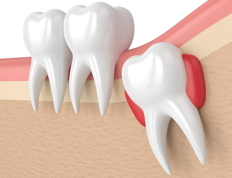 Wisdom Teeth Removal in Katy, TX