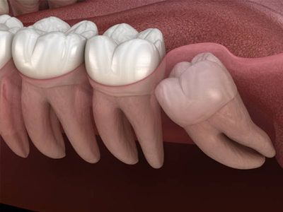 Wisdom Teeth Removal - Restorative Dentist in Katy, TX