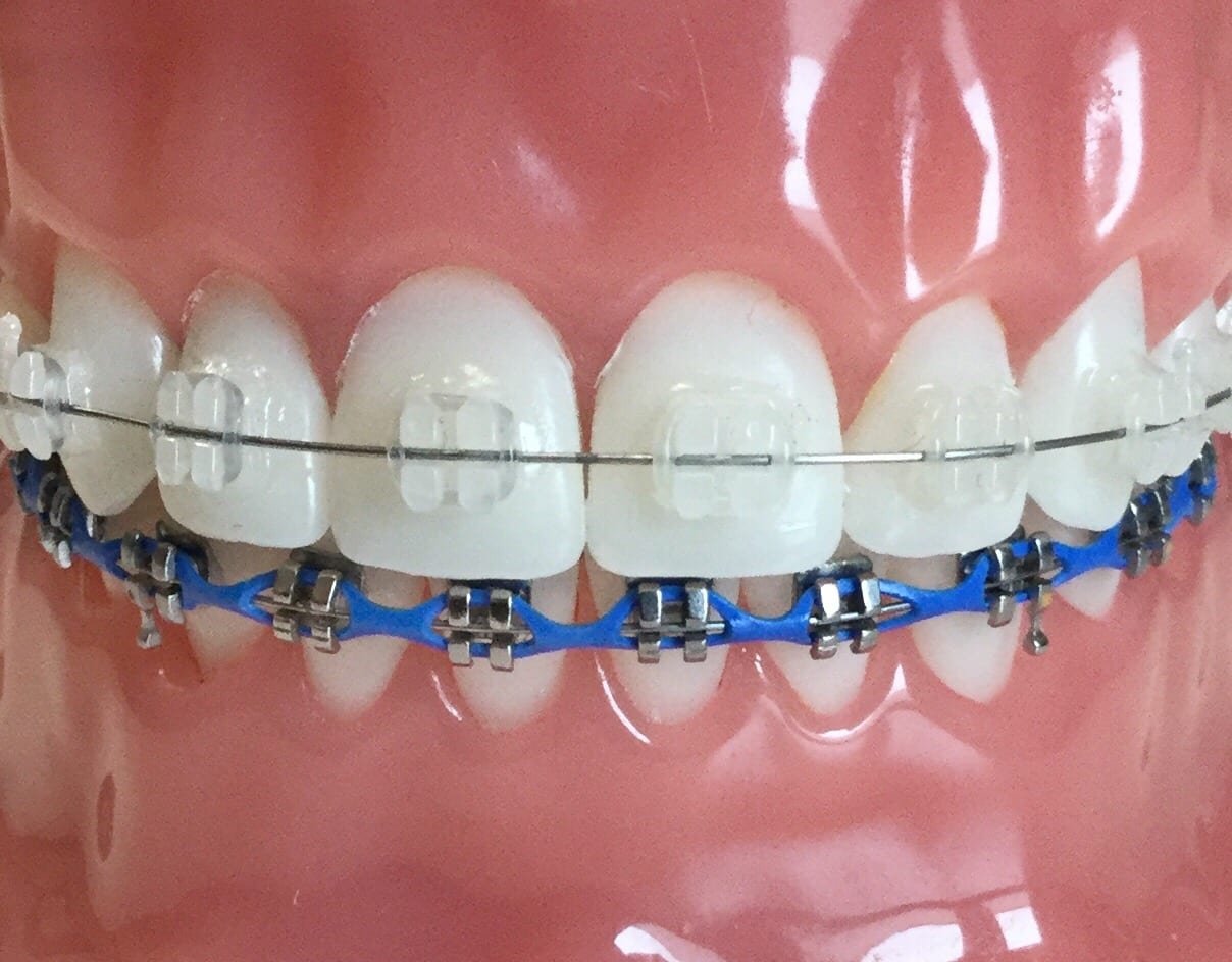 Ceramic vs Metal Braces Comparison