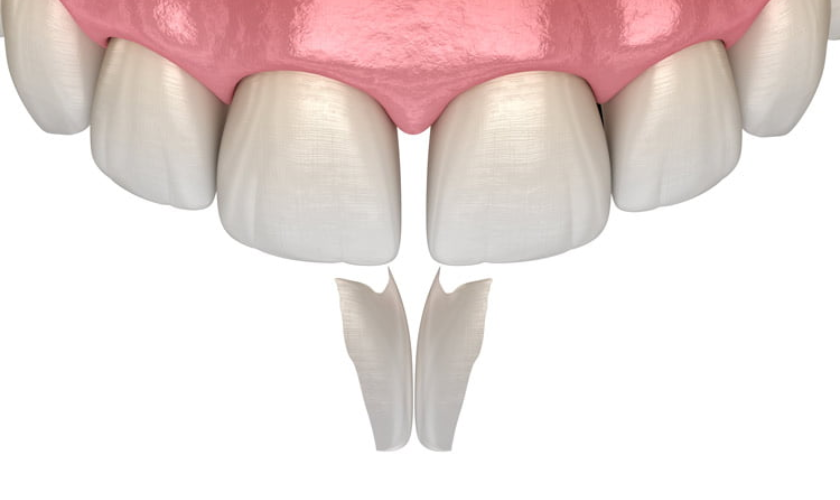 Why Choose Dental Bonding for a Chipped Tooth