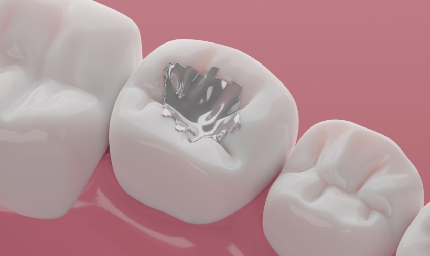 how long can composite fillings last